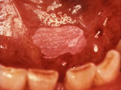 Рак рта, симптомы и  факторы риска развития заболевания
