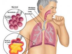 Домашняя (внебольничная) пневмония