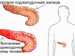 Билиарный панкреатит и желчекаменная болезнь 
