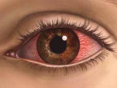 приступ глаукомы симптомы