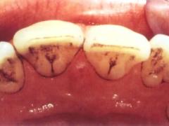 черные полоски на зубах, лечение