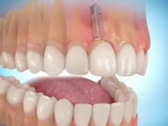 имплантация зуба