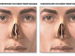 выпрямление носовой перегородки