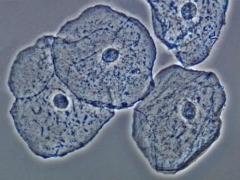 клетки плоского эпителия в моче