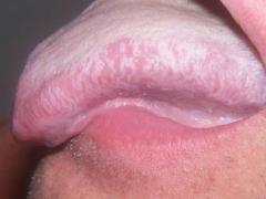 волосатая лейкоплакия языка
