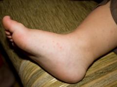 сыпь на ступнях ног