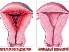 очаговая гиперплазия эндометрия лечение4