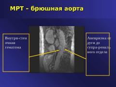 Атеросклероз брюшного отдела аорты лечение