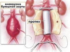 Атеросклероз брюшного отдела аорты, симптомы, диагностика, лечение