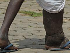 слоновья нога болезнь