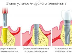 имплантация зубов показания
