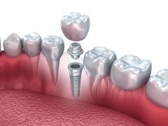 имплантация зубов противопоказания