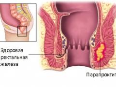 парапроктит у грудничков