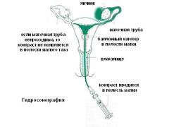 Беременность после ГСГ маточных труб
