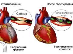 стентирование сосудов сердца