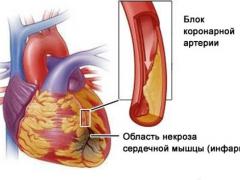 стентирование сосудов сердца