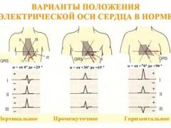 Вертикальное положение электрической оси сердца