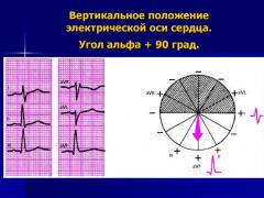 Вертикальное положение электрической оси сердца