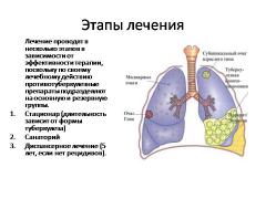 лечение туберкулеза