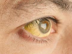 желтеют белки глаз