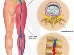 анатомия седалищного нерва