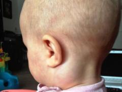 увеличены лимфоузлы на шее у ребенка