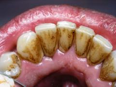 налет на внутренней части зубов