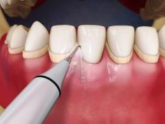 уделение зубного камня в стоматологическом кабинете