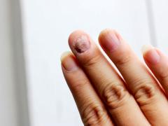 грибковое поражение ногтей