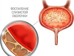 заболевания органов мочеполовой системы