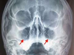 дополнительные исследования при воспалении гайморовых пазух, рентгеновский снимо