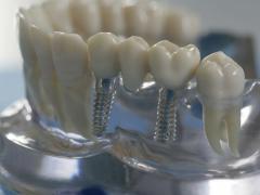 Иногда только имплантация может помочь решить проблемы с зубами