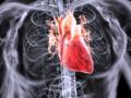 постмиокардический кардиосклероз
