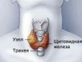 Операция на щитовидную железу последствия