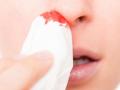 почему течет кровь из носа часто