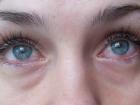 травма роговицы глаза лечение