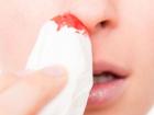 почему течет кровь из носа часто
