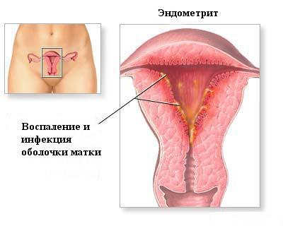 эндометрит