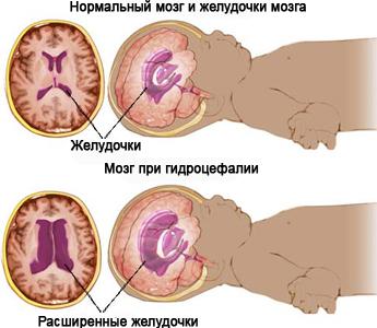 гидроцефалия головного мозга