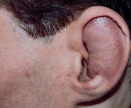 Гематома уха