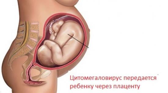 цмв при беременности