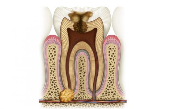 гранулема корня зуба