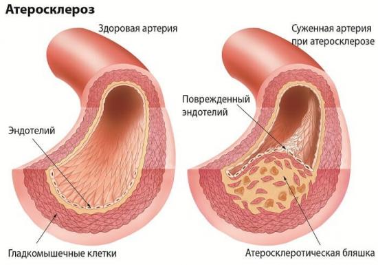 атеросклероз брюшного отдела аорты