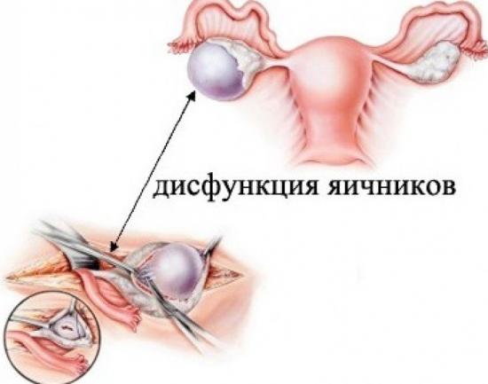 дисфункция яичников лечение народными средствами