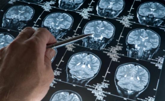 компьютерная томография головного мозга