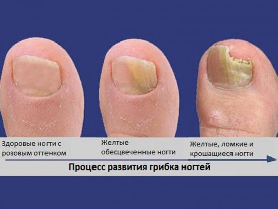 Средства для лечения грибка ногтей на ногах