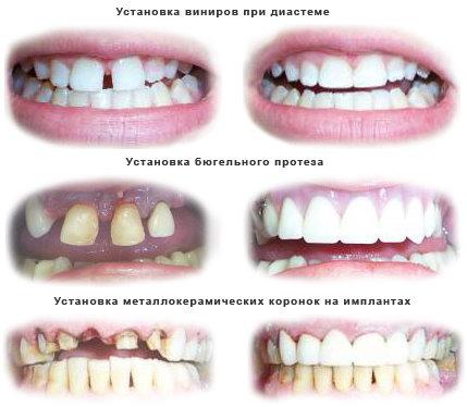 виды зубного протезирования
