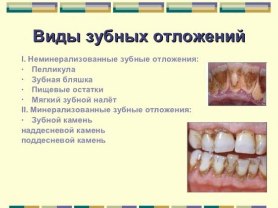 виды зубного налета