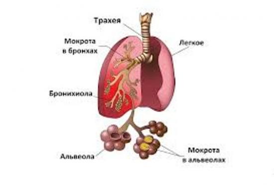 пневмония