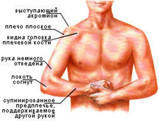 вывих плечевого сустава симптомы